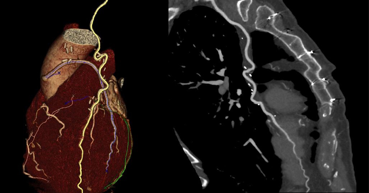 Cardio TAC a Sciacca: quando è davvero necessaria e come interpretare i risultati