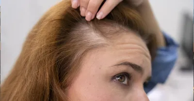 Caduta dei capelli: le cause principali e quando preoccuparsi