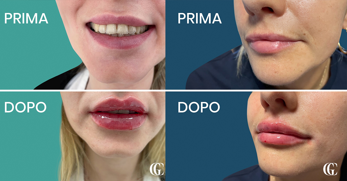 Sempre più si sente parlare di Filler e Botox: qual è la differenza? Guida essenziale per chi vuole valorizzare la propria bellezza