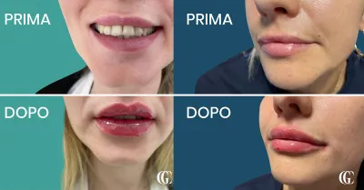 Sempre più si sente parlare di Filler e Botox: qual è la differenza? Guida essenziale per chi vuole valorizzare la propria bellezza