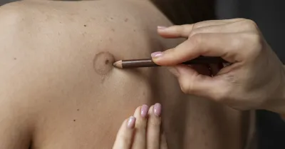 Melanoma e sole: i segnali da riconoscere subito e come difenderti in estate