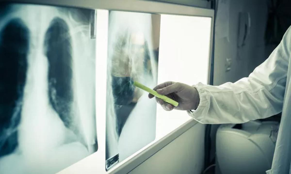 Tumori, la Regione da il via ai nuovi percorsi terapeutici: dal cancro al polmone alle neoplasie rare